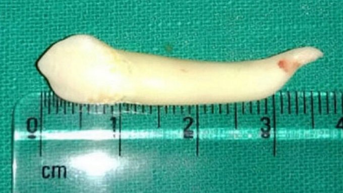 Un Indien de 20 ans s’est vu retirer une dent de 3,9 cm, la dent la plus longue du monde. © IntEngineering, Twitter